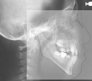 トレースの施行