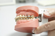 歯科矯正用アンカースクリュー